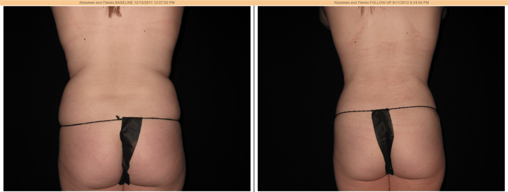 SmartLipo Before & After - Flanks (love handles)