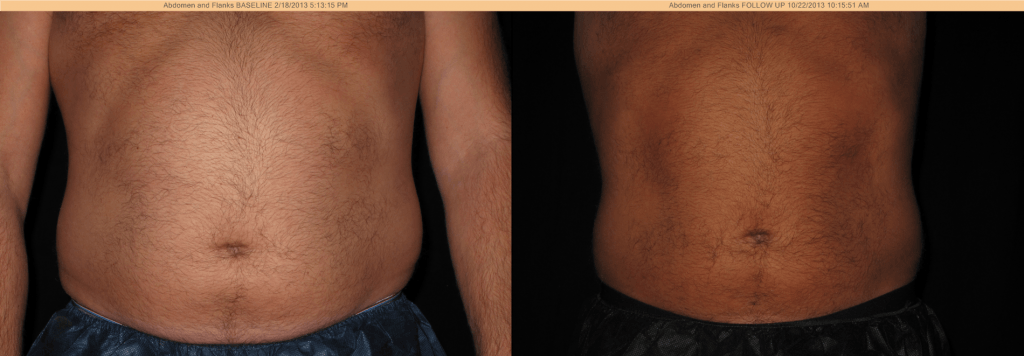 CoolSculpting Before & After - Abdomen and Flanks