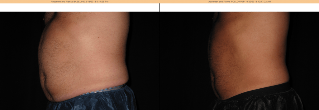 CoolSculpting Before & After - Abdomen and Flanks