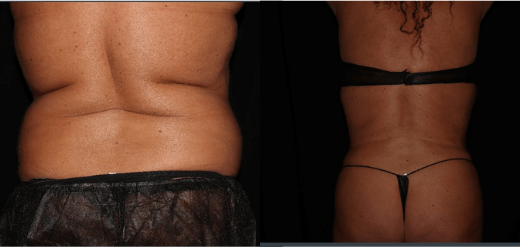 Body Contouring & Curves By SmartLipo