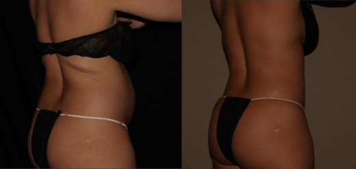 SmartLipo 360 Before & After