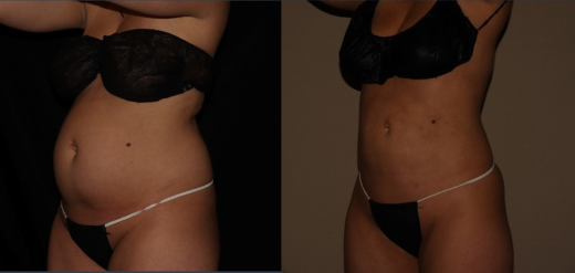 SmartLipo 360 Before & After