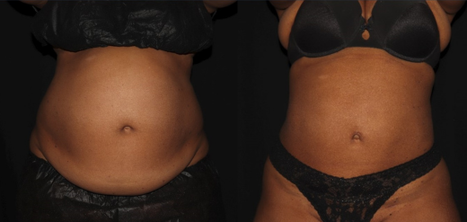 SmartLipo 360 Before & After Philly