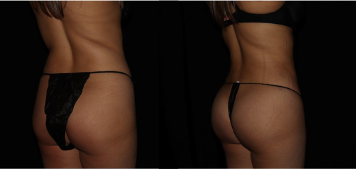 SmartLipo BBL Before & After