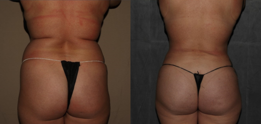 SmartLipo 360 BBL Before & After