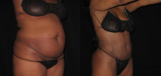 SmartLipo 360 Before & After Belly Fat