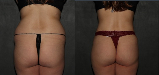 Liposuction before and after Philadelphia, PA