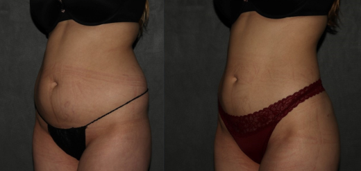 Liposuction before and after Philadelphia, PA
